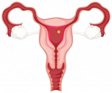Ovarian Cyst - Stuti Fertility