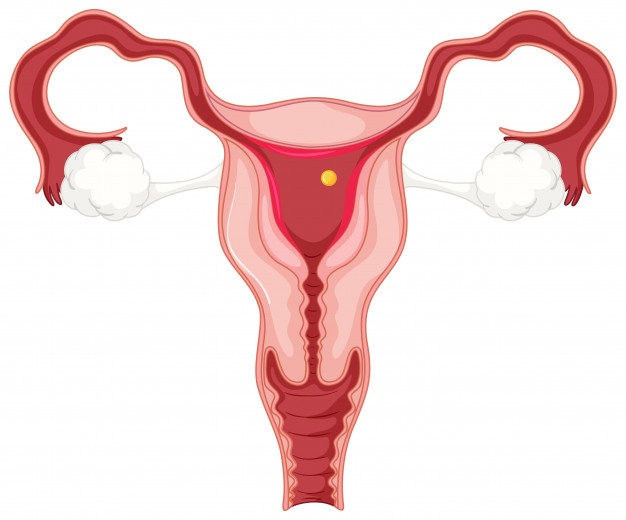 Ovarian Cyst - Stuti Fertility
